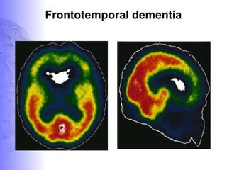 Frontotemporal dementia
 
