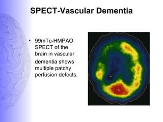SPECT-Vascular Dementia
• 99mTc-HMPAO
SPECT of the
brain in vascular
dementia shows
multiple patchy
perfusion defects.
 