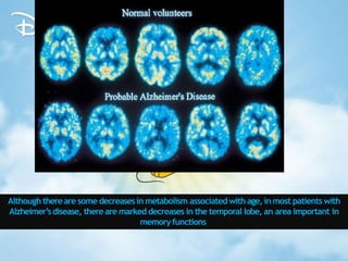 Although thereare some decreasesin metabolism associated with age, in most patients with
Alzheimer’sdisease, there are marked decreases in the temporal lobe, an area important in
memoryfunctions.
 