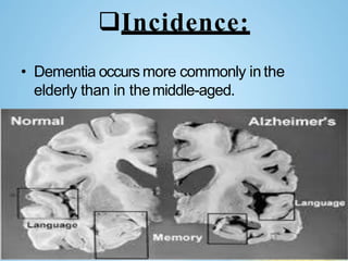 Incidence:
• Dementia occurs more commonly in the
elderly than in themiddle-aged.
 