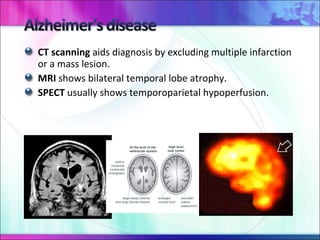 CT scanning  aids diagnosis by excluding multiple infarction or a mass lesion. MRI  shows bilateral temporal lobe atrophy. SPECT  usually shows temporoparietal hypoperfusion. 