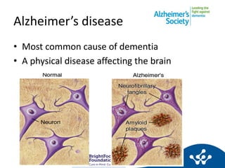 Alzheimer’s disease
• Most common cause of dementia
• A physical disease affecting the brain
• Protein ‘plaques’ and ‘tang...
