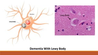 Dementia With Lewy Body
 