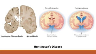 Huntington's Disease
 