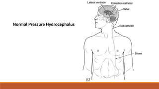 Normal Pressure Hydrocephalus
Shunt
 