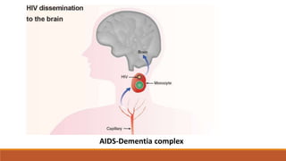 AIDS-Dementia complex
 