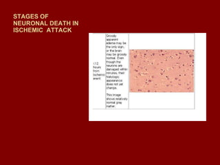 STAGES OF NEURONAL DEATH IN ISCHEMIC  ATTACK 