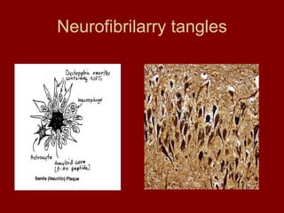Neurofibrilarry tangles 
