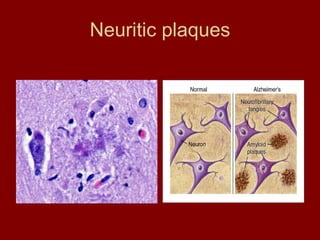 Neuritic plaques 