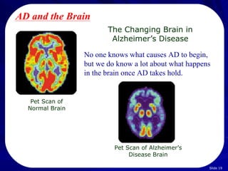 AD and the Brain
                        The Changing Brain in
                         Alzheimer’s Disease

                 No one knows what causes AD to begin,
                 but we do know a lot about what happens
                 in the brain once AD takes hold.


   Pet Scan of
  Normal Brain




                          Pet Scan of Alzheimer’s
                               Disease Brain

                                                       Slide 19
 