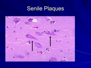 Senile Plaques
 