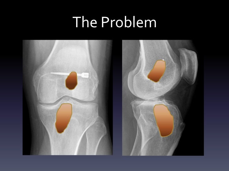 Demineralized bone matrix