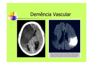 Demência Vascular
 