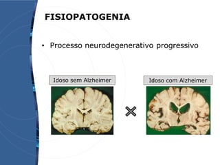 • Processo neurodegenerativo progressivo
FISIOPATOGENIA
Idoso sem Alzheimer Idoso com Alzheimer
 