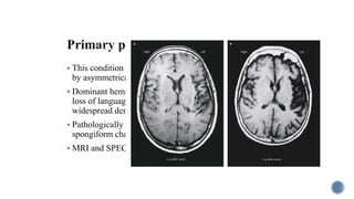  This condition is one of a group of disorders characterized
by asymmetrical cortical degeneration.
 Dominant hemisphere perisylvian atrophy is associated with
loss of language, which, after many years, becomes a more
widespread dementia.
 Pathologically non-specific cell loss, Pick’s pathology or
spongiform changes are described.
 MRI and SPECT confirm focal changes.
 