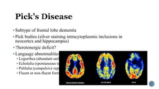 Subtype of frontal lobe dementia
Pick bodies (silver staining intracytoplasmic inclusions in
neocortex and hippocampus)
?Serotonergic deficit?
Language abnormalities and behavioral disturbances
 Logorrhea (abundant unfocused speech)
 Echolalia (spontaneous repetition of words/phrases)
 Palilalia (compulsive repetition of phrases)
 Fluent or non-fluent forms
 