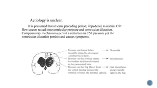 Aetiology is unclear.
It is presumed that at some preceding period, impedence to normal CSF
flow causes raised intraventricular pressure and ventricular dilatation.
Compensatory mechanisms permit a reduction in CSF pressure yet the
ventricular dilatation persists and causes symptoms.
 