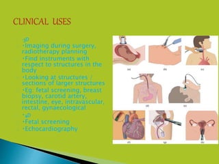  3D
 Imaging during surgery,
radiotherapy planning
 Find instruments with
respect to structures in the
body
 Looking at structures /
sections of larger structures
 Eg: fetal screening, breast
biopsy, carotid artery,
intestine, eye, intravascular,
rectal, gynaecological
 4D
 Fetal screening
 Echocardiography
 