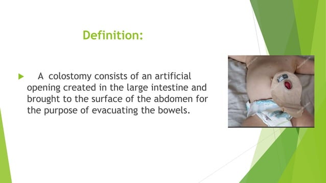 Demo Colostomy Pptx In Child Health Nursing Ppt