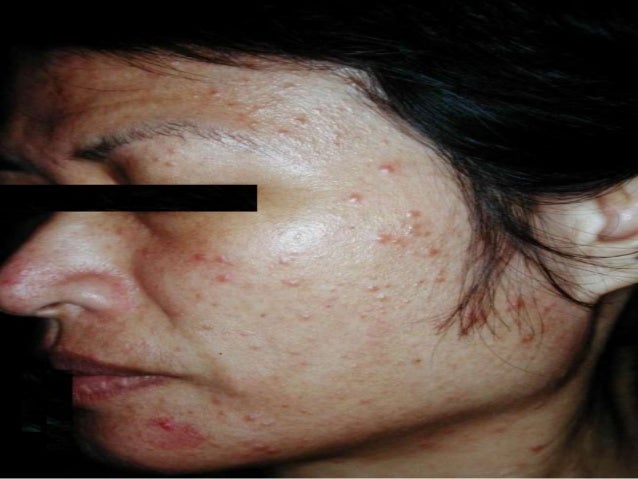 Rosacea - the Environ Solution | mySKiN&CO