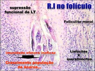 supressão
funcional de LT

                             Foliculite mural




imunidade efetora ineficaz      Linfócitos
                                    X
                              queratinócitos
Crescimento população
     de ácaros...
 