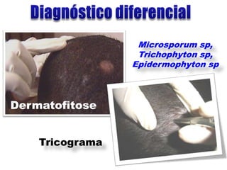 Microsporum sp,
                  Trichophyton sp,
                 Epidermophyton sp



Dermatofitose


    Tricograma
 