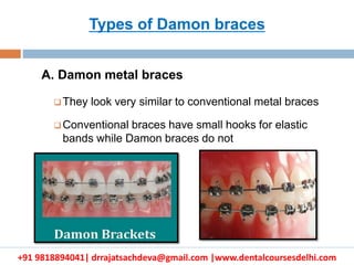 +91 9818894041| drrajatsachdeva@gmail.com |www.dentalcoursesdelhi.com
A. Damon metal braces
 They look very similar to conventional metal braces
 Conventional braces have small hooks for elastic
bands while Damon braces do not
Types of Damon braces
 