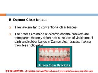 +91 9818894041| drrajatsachdeva@gmail.com |www.dentalcoursesdelhi.com
B. Damon Clear braces
 They are similar to conventional clear braces.
 The braces are made of ceramic and the brackets are
transparent the only difference is the lack of visible metal
parts and rubber bands in Damon clear braces, making
them less noticeable
 