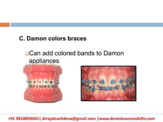 +91 9818894041| drrajatsachdeva@gmail.com |www.dentalcoursesdelhi.com
C. Damon colors braces
Can add colored bands to Damon
appliances
 
