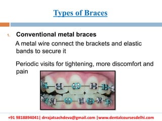 +91 9818894041| drrajatsachdeva@gmail.com |www.dentalcoursesdelhi.com
1. Conventional metal braces
A metal wire connect the brackets and elastic
bands to secure it
Periodic visits for tightening, more discomfort and
pain
Types of Braces
 