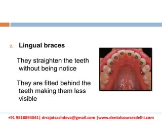 +91 9818894041| drrajatsachdeva@gmail.com |www.dentalcoursesdelhi.com
2. Lingual braces
They straighten the teeth
without being notice
They are fitted behind the
teeth making them less
visible
 
