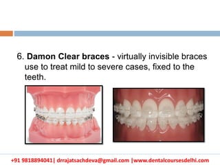 +91 9818894041| drrajatsachdeva@gmail.com |www.dentalcoursesdelhi.com
6. Damon Clear braces - virtually invisible braces
use to treat mild to severe cases, fixed to the
teeth.
 