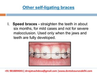+91 9818894041| drrajatsachdeva@gmail.com |www.dentalcoursesdelhi.com
I. Speed braces - straighten the teeth in about
six months, for mild cases and not for severe
malocclusion. Used only when the jaws and
teeth are fully developed.
Other self-ligating braces
 