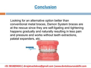 +91 9818894041| drrajatsachdeva@gmail.com |www.dentalcoursesdelhi.com
Looking for an alternative option better than
conventional metal braces, Damon System braces are
at the rescue since they are self-ligating and tightening
happens gradually and naturally resulting in less pain
and pressure and works without teeth extractions,
palatal expanders, etc.
Conclusion
 