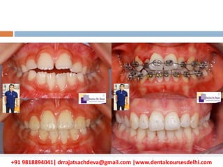 +91 9818894041| drrajatsachdeva@gmail.com |www.dentalcoursesdelhi.com
 