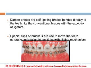Types of Braces, Connor Orthodontics