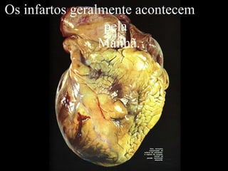 Os infartos geralmente acontecem  pela  Manhã. 