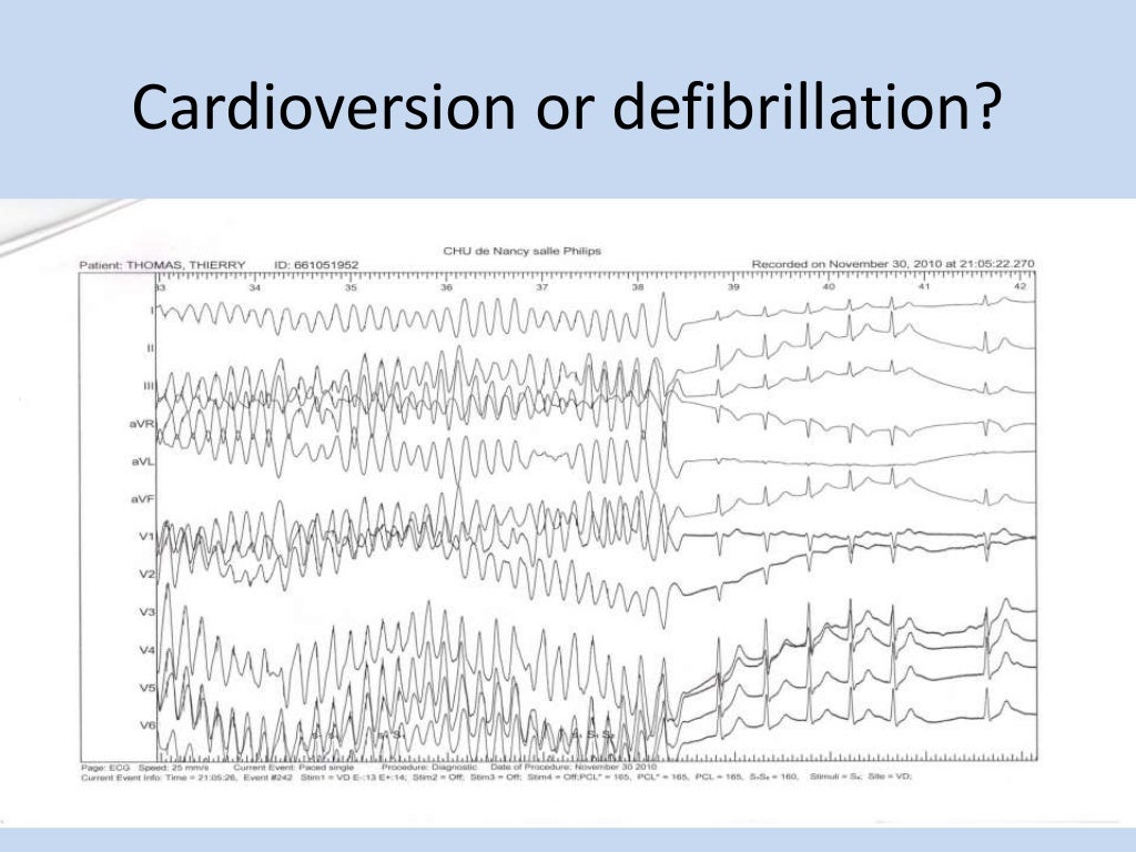 Cardioversion and Defibrillation