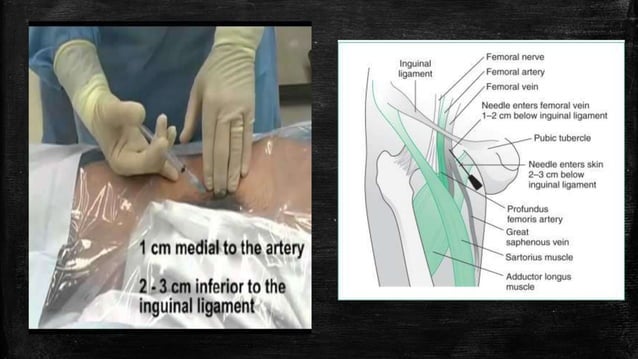 Center Line Insertion Demonstration of central line insertion | PPTX