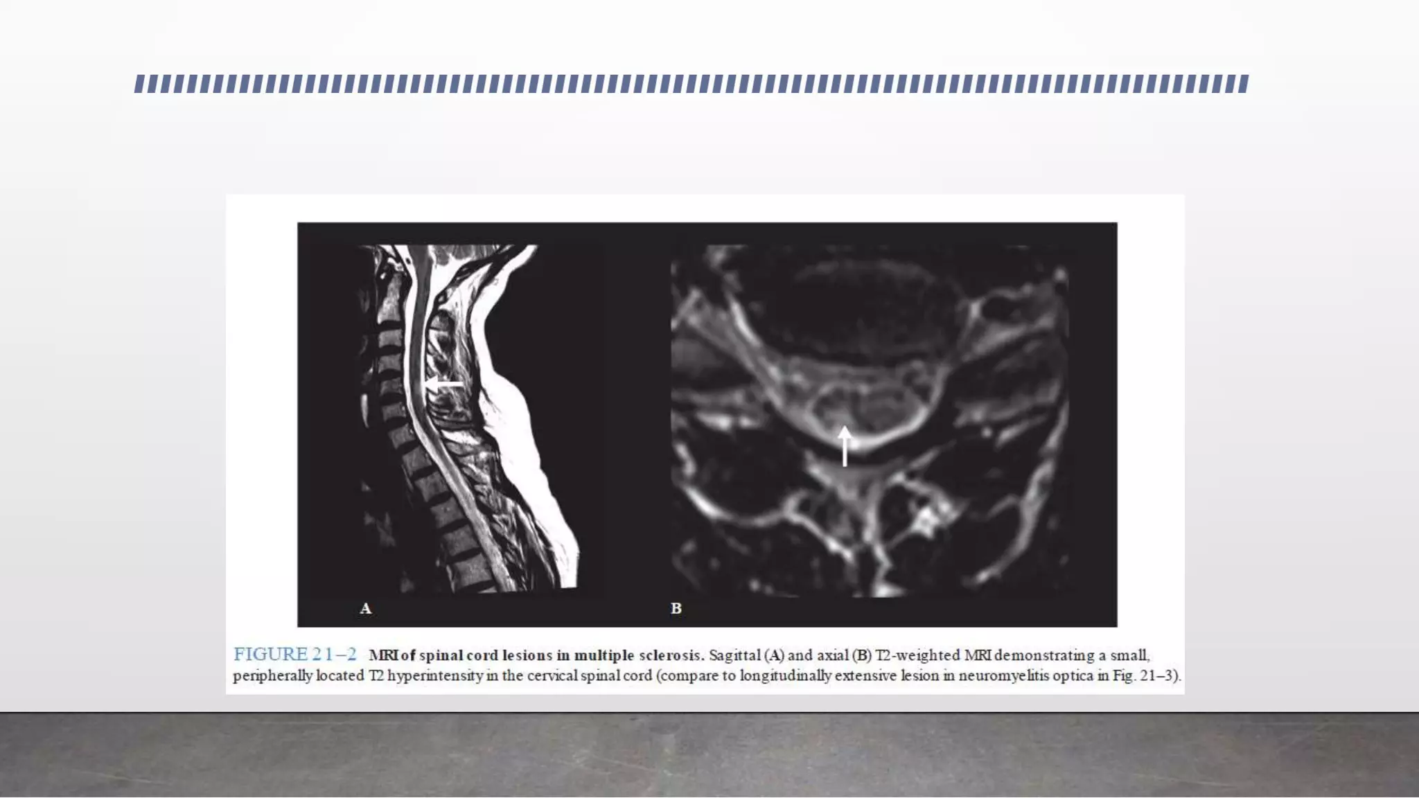 Demyelinating diseases of the central nervous system | PPTX
