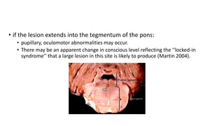 • if the lesion extends into the tegmentum of the pons:
• pupillary, oculomotor abnormalities may occur.
• There may be an apparent change in conscious level reflecting the ‘‘locked-in
syndrome’’ that a large lesion in this site is likely to produce (Martin 2004).
 