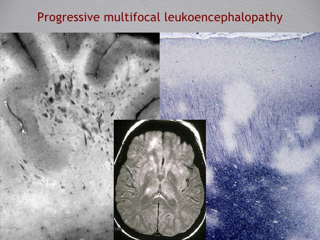 Pathology of Demyelinating Disease
