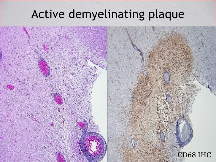 Pathology of Demyelinating Disease