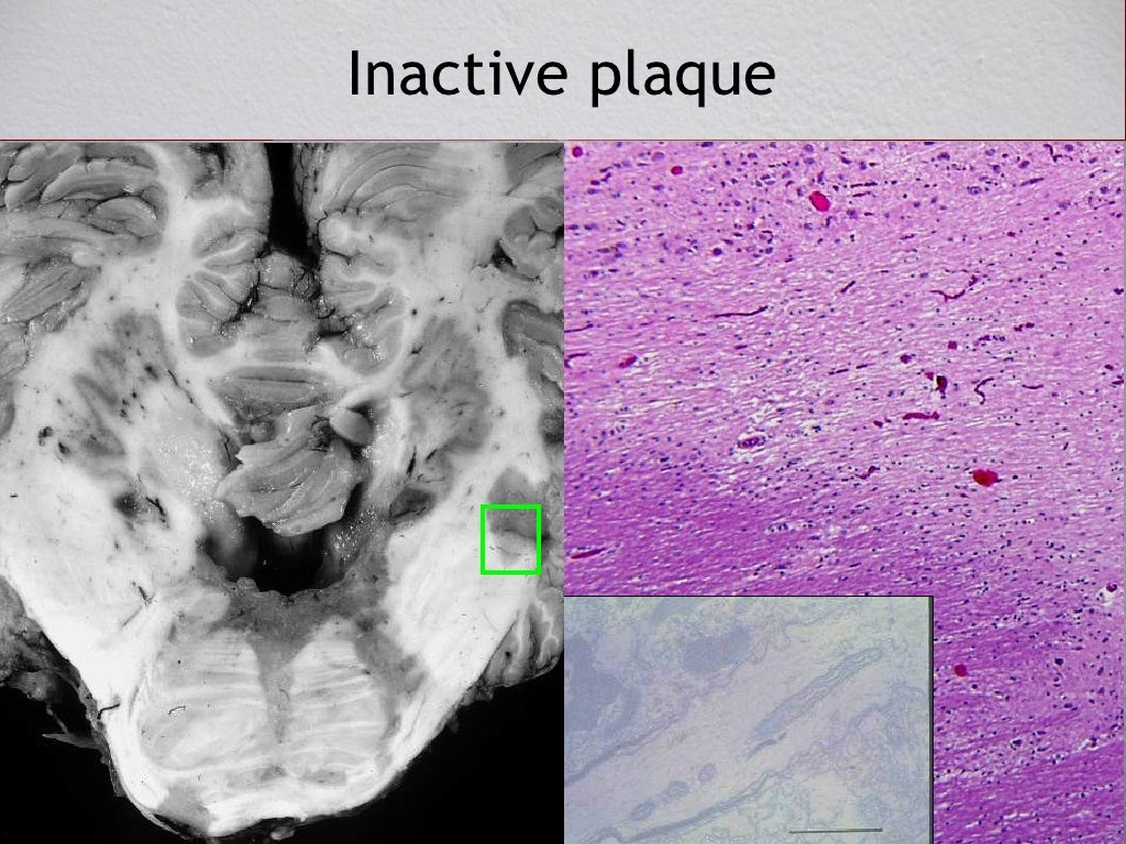 Pathology of Demyelinating Disease