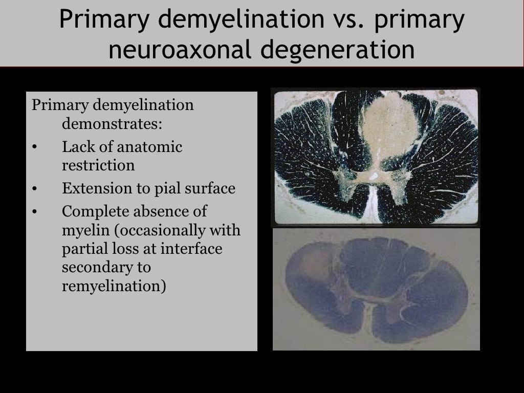 Pathology of Demyelinating Disease