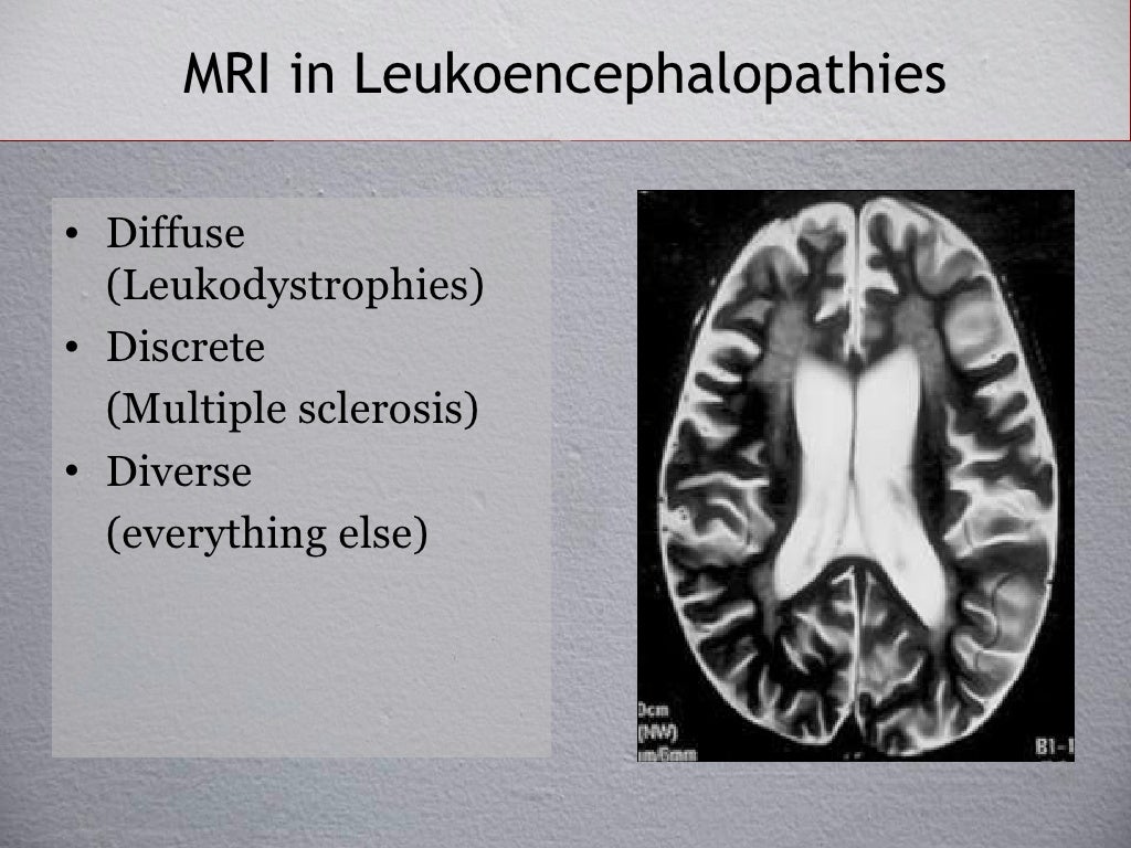 Pathology of Demyelinating Disease
