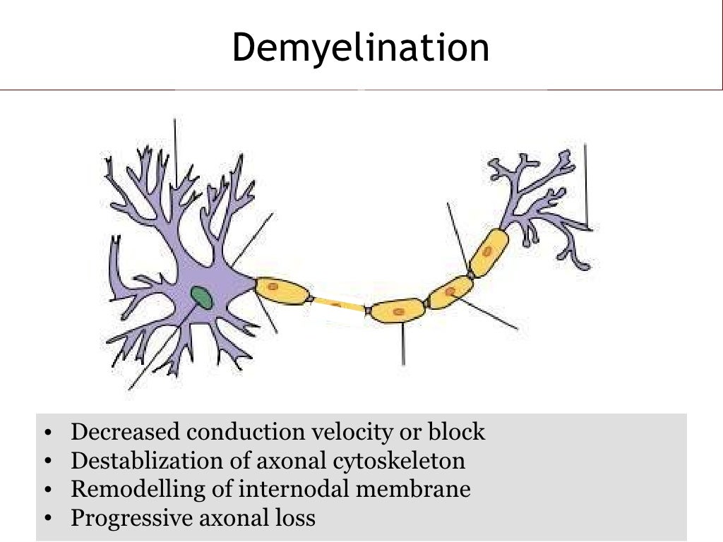 Pathology of Demyelinating Disease