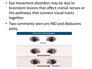 • Eye movement disorders may be due to
brainstem lesions that affect cranial nerves or
the pathways that connect visual tracts
together.
• Two commonly seen are INO and Abducens
palsy.
 