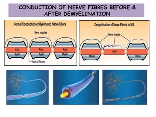 CONDUCTION OF NERVE FIBRES BEFORE &
AFTER DEMYELINATION
 