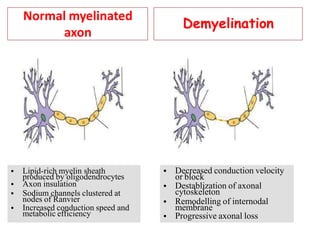 Normal myelinated
axon
nodes of Ranvier
• Lipid-rich myelin sheath
produced by oligodendrocytes
• Axon insulation
• Sodium channels clustered at
• Increased conduction speed and
metabolic efficiency
Demyelination
or block
cytoskeleton
• Decreased conduction velocity
• Destablization of axonal
• Remodelling of internodal
membrane
• Progressive axonal loss
 
